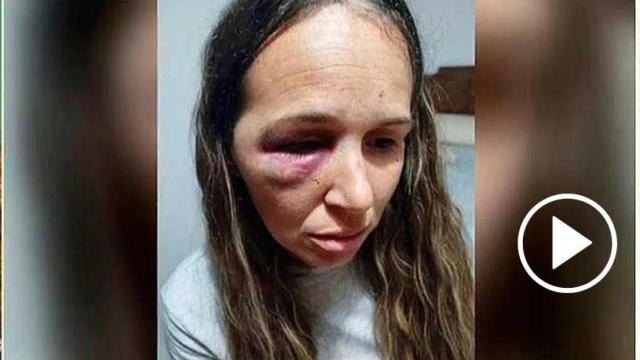 Eloísa, con las marcas de la paliza que ha denunciado en El programa de AR, de Tele5.