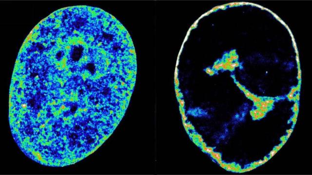Células humanas antes y después de la infección por el herpes labial.