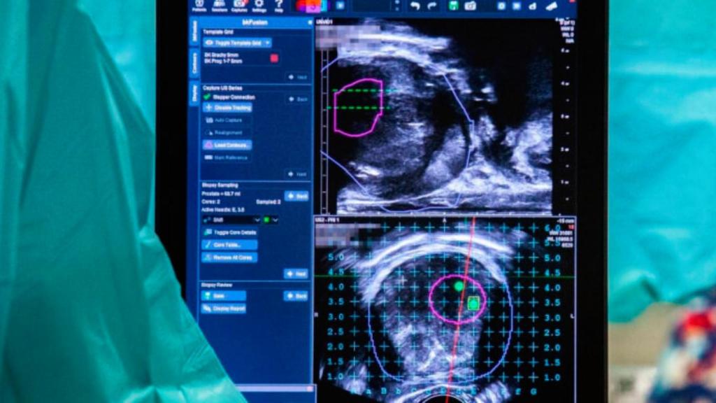Imagen de una biopsia de próstata por fusión, realizado como parte un estudio de detección de cáncer.